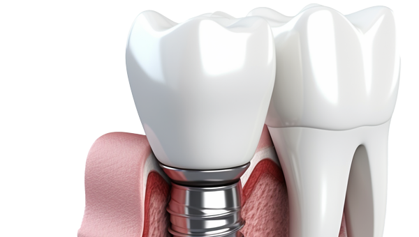 Dental Implants