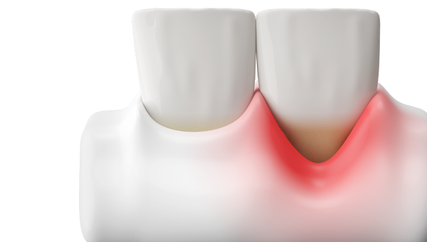 Tooth Extractions